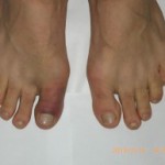 Как лечить ушиб пальца на ноге