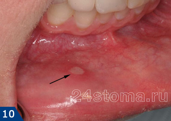 Афтозный стоматит (афта локализована на внутренней поверхности нижней губы)