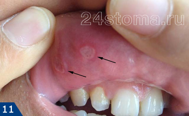 Афтозный стоматит (две одиночных афты локализованы на внутренней поверхности верхней губы)
