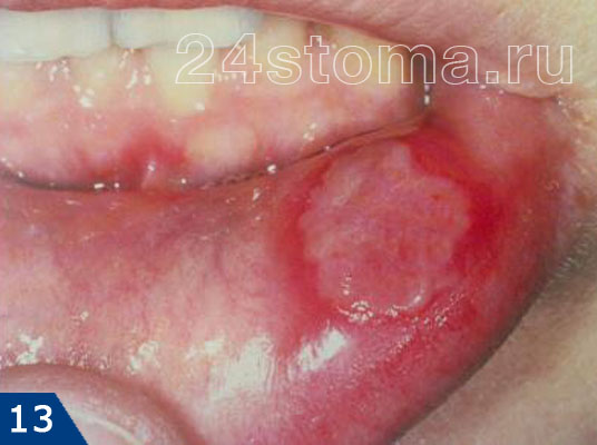 Афтозный стоматит (одиночная афта локализована на внутренней поверхности нижней губы - красной кайме губы)