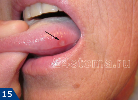 Афтозный стоматит (одиночная афта локализована на боковой поверхности языка)