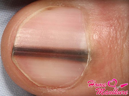 черные поперечные полоски на ногтях