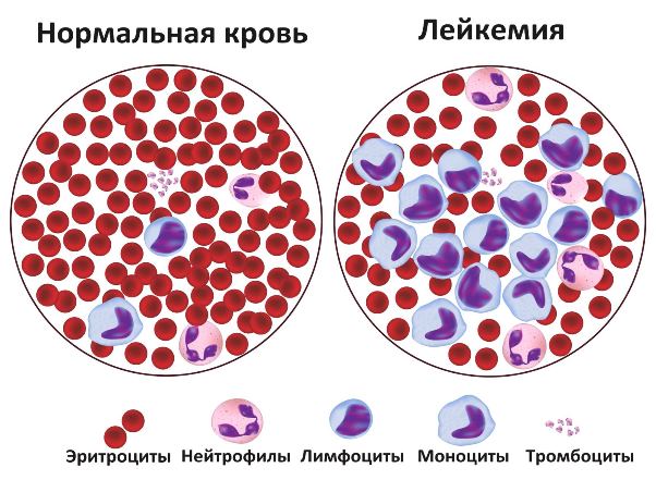 рак крови схема