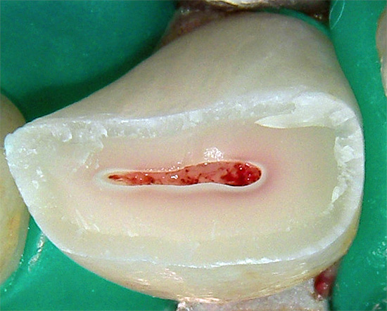 На фотографии показан сломанный зуб - из него тоже придется удалять нерв.