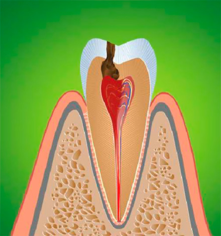 Воспаление зубного нерва приводит к пульпиту, который обычно сопровождается острой болью.
