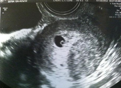 Эмбрион на 5-ой неделе