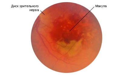макуладистрофия сетчатки глаза