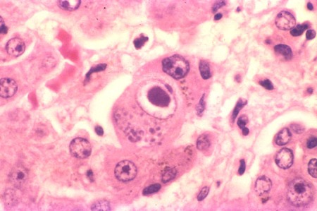 Результат анализа на цитомегаловирус при беременности под микроскопом