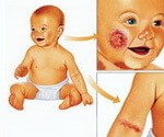 Проявления атопического дерматита на лице и руке у младенца