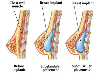 Увеличение груди при помощи имплантов