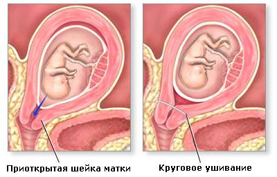 Истмико-цервикальная недостаточность. Хирургическое сужение канала шейки матки (зашивание)