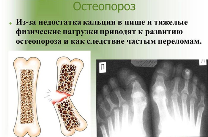 Боли при остеопорозе