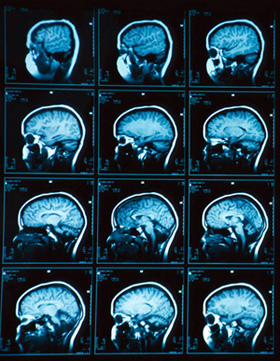 что показывают снимки МРТ головного мозга