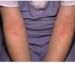 Аллергический дерматит на руках ребенка