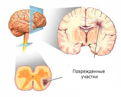 Мозг при рассеянном склерозе