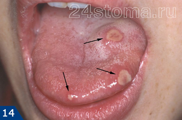 Афтозный стоматит на языке (три одиночных афты момечены стрелочками)