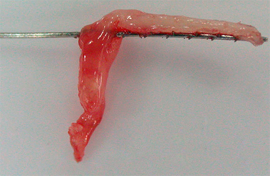 Фотография удаленного из зуба нерва (пульпа)