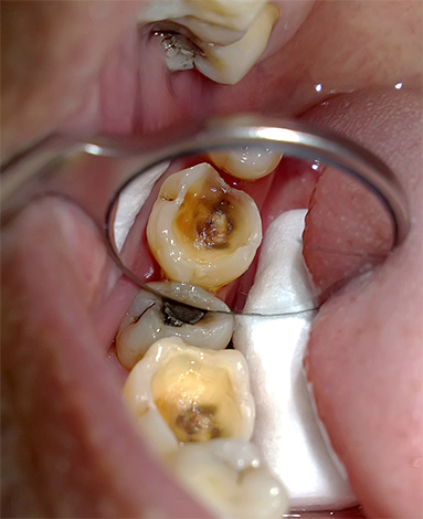На фото показан кариозный зуб, подготавливаемый для эндодонтического лечения.