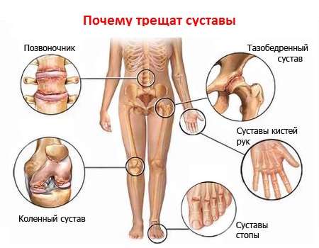 Артрит и артроз (заболевания суставов) - отличие и как лечить