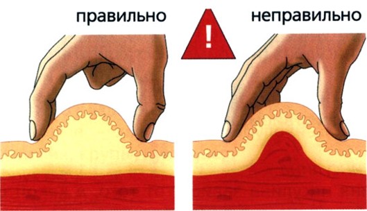 Как правильно делать укол в ягодицу