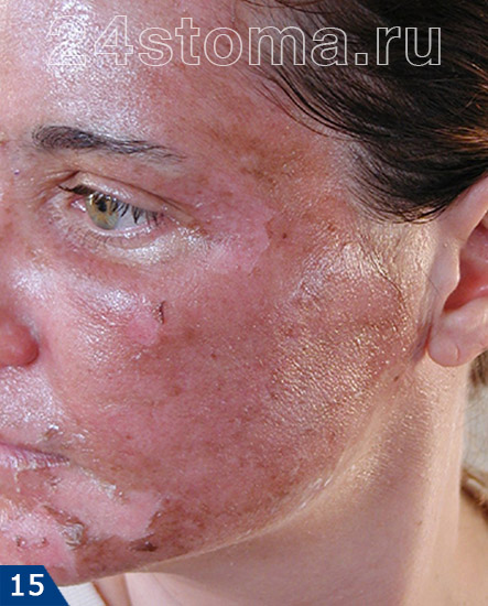 Ожог кожи лица в результате ошибок врача при использовании химического пилинга