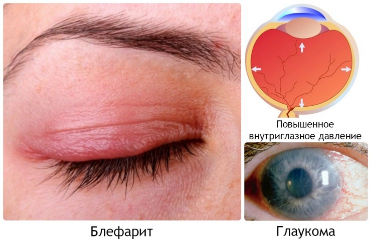 Разновидность заболеваний глаз