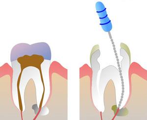 Удаление нерва в зубе