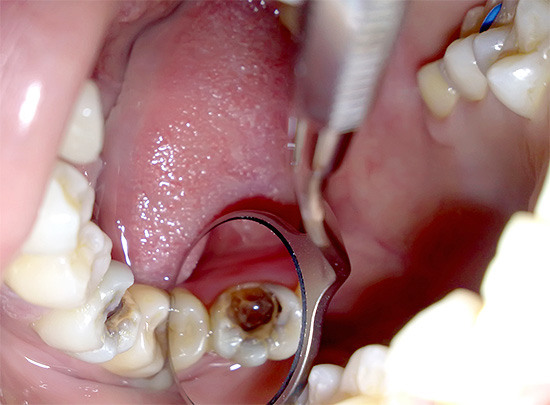 Рассмотрим основные этапы, из которых складывается процедура удаления нерва из зуба.