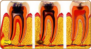 Мышьяк в зубе – способ «убить» нерв