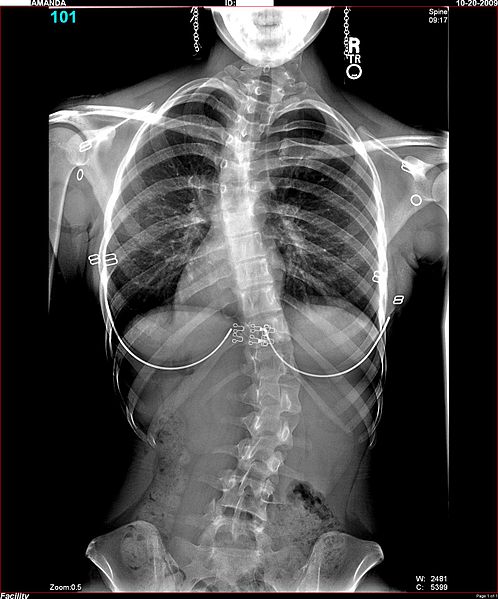 Рентгеновский снимок сколиоза