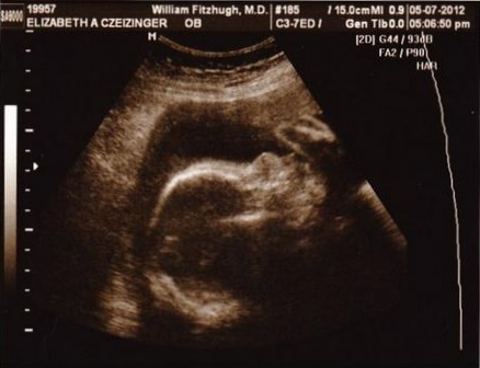 Ультразвуковое исследование на двадцать седьмой недели беременности
