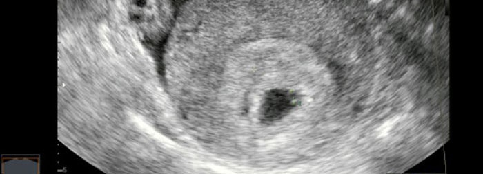 Снимок УЗИ на четвёртой неделе беременности