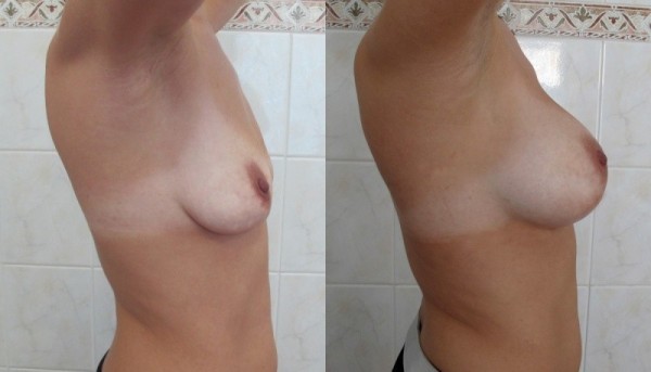 грудные импланты - до и после
