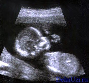 Фото УЗИ в 18 недель беременности