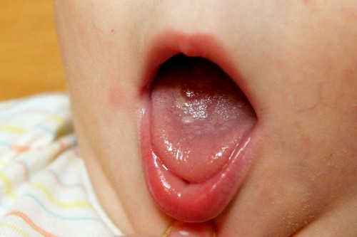 В том случае, если ребенок страдает от аллергии, пятна могут быть одним из ее проявлений